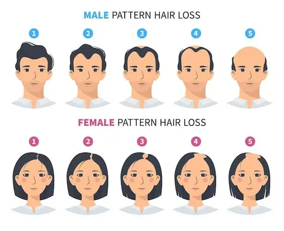 hair loss pattern male & female
